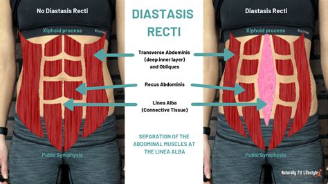 What is Diastasis Recti Repair: Exploring the Myths and Realities of Postpartum Recovery